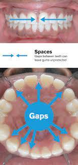 How long will it take for braces to work. Gaps Between Teeth Before And After Braces Viechnicki Orthodontics