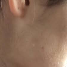 Habe Im Gesicht An 2 Stellen Weisse Flecken Gesundheit Beauty