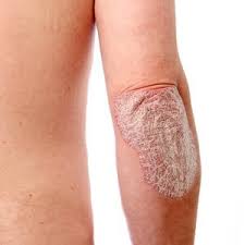 Image result for PSORIASIS