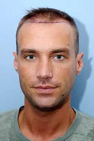 Before the procedure: Calum Best underwent a hair transplant after going bald made his confidence. Hair today: The benefits of Calum&#39;s procedure are already ... - article-2222950-15AD509E000005DC-677_306x462