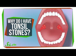 Black And White Spots On Tonsils Pin On Fit Fuck Fat