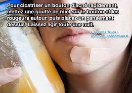 Certainement Le Meilleur Remede Pour Cicatriser Un Bouton En 1 Nuit