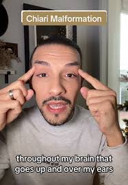 Understanding Chiari Malformation Symptoms and Relief