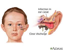 Swimmer S Ear An Infection Of The Skin Lining The Ear Canal Bacteria Can Enter The Skin Ear Infection Home Remedies Home Remedies For Earache Ear Infection