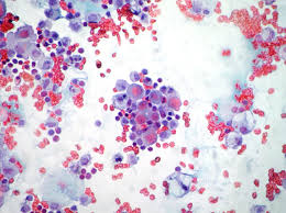 pleural fluid cytology examination from a patient with malignant mesothelioma. Effusions Cytopathology Cellnetpathology