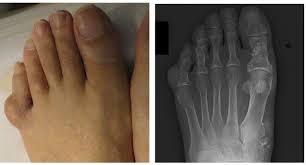 Maffucci Syndrome Intechopen