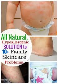 The Only Natural Solution That Has Worked For A Variety Of Family Skincare Conditions Eczema Remedies Natural Solutions Eczema