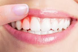 The Holistic Approach To Gum Disease Holistic Dental Center Nj