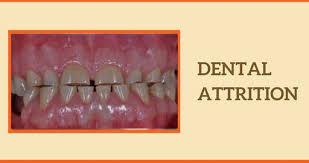 Image result for Tooth Attrition