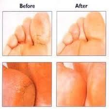 от чего трескаются пятки и как с этим бороться Dry Cracked Feet And How To Fix Them Dry Cracked Feet Health And Beauty Tips Foot Remedies
