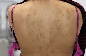 How to get rid of bacne, back acne scars that need treatment like natural remedies and revitol scar cream. Pin On Clear Skin Detox