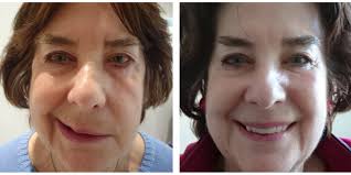 With bell's palsy, your face droops on one side or, rarely, both sides. Caci For Bell S Palsy Melior Clinics