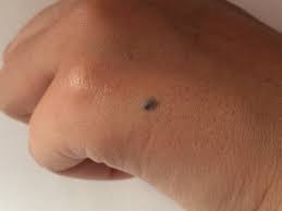 Grauer Fleck An Der Hand Was Konnte Es Sein Gesundheit Haut Leberfleck