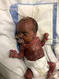 Babies born at 26 weeks: Beautiful Baby Boy Born 10 Weeks Premature Without Any Skin Defies The Odds To Finally Return Home