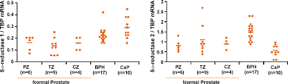 Kim j, amos ci, logothetis c. Type 1 And Type 2 5a Reductase Expression In The Development And Progression Of Prostate Cancer European Urology