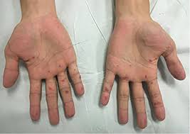 But it might appear on arms, face and the trunk. Racgp Purpuric Rash In A Young Adult