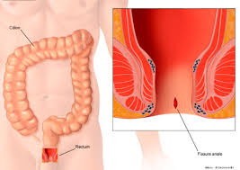 اعراض الناسور عند النساء Health Power