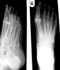 Time to complete healing, defined as the time to full clinical and radiographic healing, was also measured. The Foot
