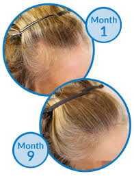 It is true that rogaine works for thinning hair. Thinning Hair At Temples After Using Minoxidil For 15 Years