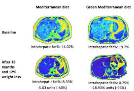 Home » apps » health & fitness » mediterranean diet app plan 1.2 apk. Green Mediterranean Diet Cuts Non Alcoholic Fatty Liver Disease By Half