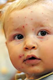 Image result for chickenpox