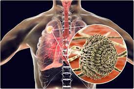 Pulmonary aspergillosis is a collective term used to refer to a number of conditions caused by infection with a fungus of the aspergillus species (usually aspergillus fumigatus). Covid 19 Associated Pulmonary Aspergillosis Caused By Aspergillus Fumigatus