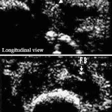 However, it can be a sign of a serious complication. Pdf Diagnosis Of Plant Thorn Synovitis By High Resolution Ultrasonography A Case Report And Literature Review
