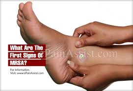The area may be tender, swollen, or warm to the touch. What Are The First Signs Of Mrsa