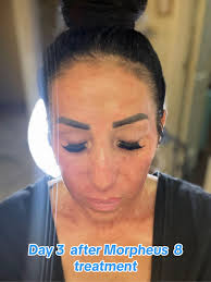 Morpheus 8 Recovery Day 3