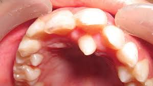 Hyperdontia Supernumerary Teeth Kids Dental In Plano And