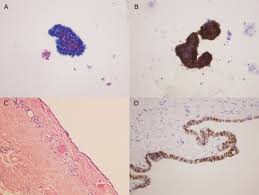 A useful combination of immunohistochemical markers for differentiating epithelioid peritoneal mesothelioma from serous papillary carcinoma of the ovary. Ber Ep4 Staining In Effusion Cytology A Potential Source Of False Positives Sciencedirect