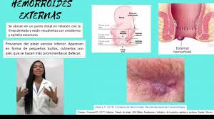 Existen dos tipos de trombosis hemorroidal, la externa y la interna. Hemorroides Externas Youtube