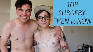 Top surgery at cosmetic surgery partners london top surgery is the most commonly performed gender reassignment surgery (grs) for f2m transsexuals. Big Brother Chris 1 Year Post Top Surgery Faq By Seethestarsablaze