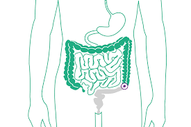 Meine Stoma Op