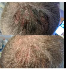 Plus, the healthy fats are known to boost skin health. Best Treatment For Scalp Psoriasis Fastway Blog