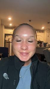 Chemical peels for skin rejuvenation and refreshment