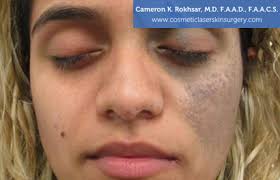 Birthmarks Removal Before and After Photos • Dr. Cameron Rokhsar