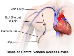 Port A Cath 101 How To Access The Port Nurse Practitioner Programs Nurse Best Nursing Schools