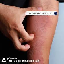 Image result for psoriasis