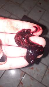 Aborto - Página 2 | BabyCenter