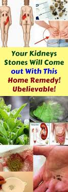 Your Kidneys Stones Will Come Out This Home Remedy Unbelievable Wieghtloss Beautyhacks Home Remedies Health Routine Health Disease