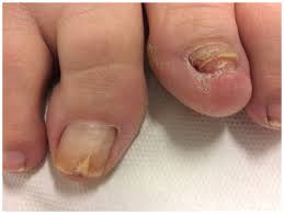Image result for Onycholysis feet