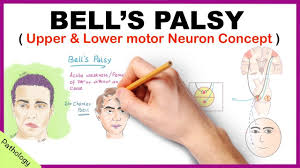 What is bell's palsy bell's palsy symptoms bell's palsy causes treatment options and prevention for bell's palsy bell's palsy is an idiopathic condition meaning that the cause is often unknown. Bell S Palsy Upper And Lower Motor Neuron Lesions Simplified Youtube