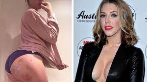 Katherine Ryan horrifies fans with pic of botched bum lift 'from unlicensed  surgeon' - Daily Star