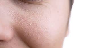 Perbedaan Whitehead Milia Dan Fungal Acne Serta Cara Mengatasinya Semua Halaman Stylo