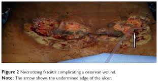 It is a very severe bacterial infection that spreads quickly through the tissue (flesh) surrounding the muscles. Necrotizing Fasciitis A Rare Complication Following Common Obs Ijwh