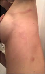 Image result for mite bites on humans