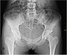 فعند عرب الشام كان يقال للزهرة الحمراء المتفتحة. Intrauterine Device Wikipedia