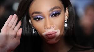 Qu'est-ce que le vitiligo, cette maladie dont est atteinte le mannequin  Winnie Harlow ?