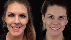 All-on-4 Dental Implants Chattanooga — Hixson Dental Group